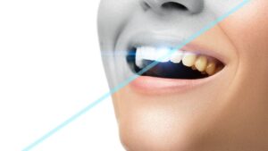 Do teeth whitening kits Work - go4healthnfitness (5)